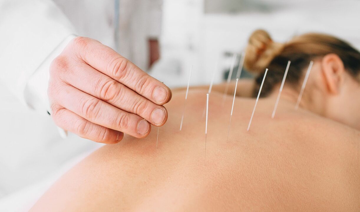 acupuncture against smoking